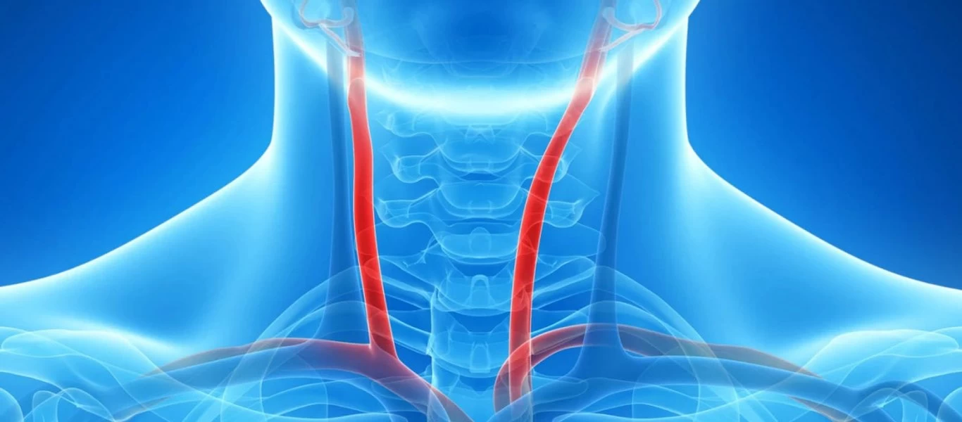 Νόσος των καρωτίδων: Τι είναι και πως να την αντιμετωπίσετε